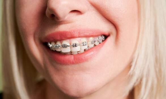 Picture of a blond woman smiling with braces on her teeth.